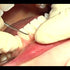 Micro Mini-Five Gracey Curettes - Hu-Friedy